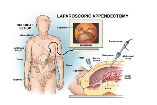 Laparoscopic Appendectomy (Appendix Surgery)
