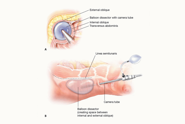 Laparoscopic Inguinal Hernia Surgery (TAPP/TEP)