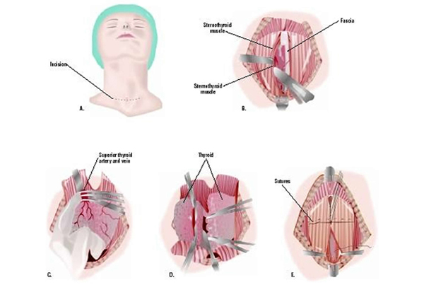 Total Thyroidectomy (MNG Thyroid Cancers)
