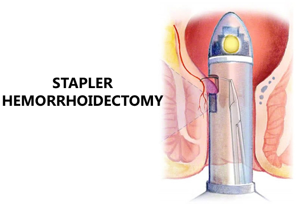 Stapled Hemorrhoidopexy (Hemorrhoids/Piles Surgery)