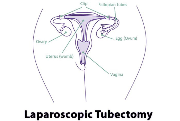 Laparoscopic Tubectomy (Female Sterilization)