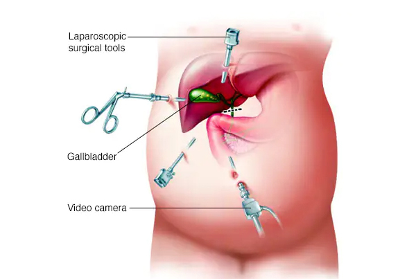 Laparoscopic Cholecystectomy (Gallbladder Stones/Polyps)