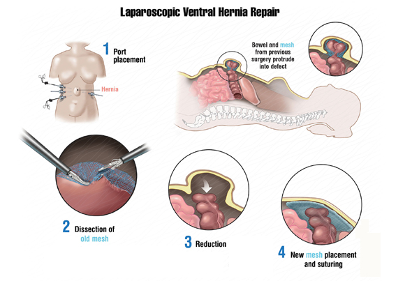 Laparoscopic Ventral Hernia Repair (IPOM)