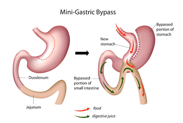 Mini Gastric Bypass (MGB)