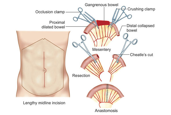 Small Intestine / Resection & Anastomosis