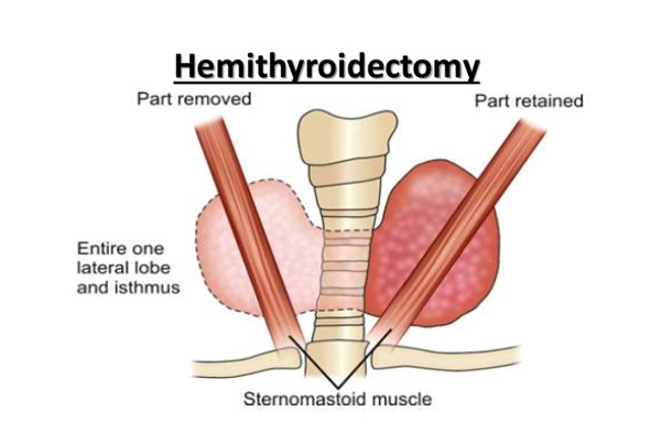 Hemithyroidectomy (Thyroid Cancer)