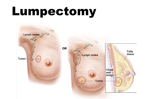 Lumpectomy (Breast Conservation Surgery)