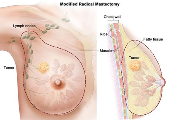 Modified Radical Mastectomy (MRM- Breast Cancers)