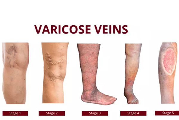 Varicose Veins Treatment (Laser/RFA)