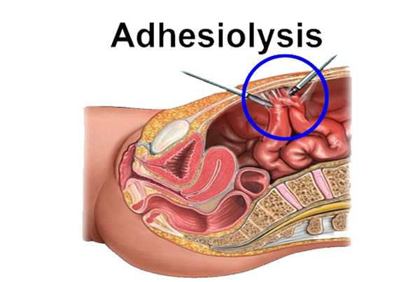 Adhesiolysis (Uterine Adhesions Removal Surgery) | Gynaecology | Curis  Multispeciality Clinic